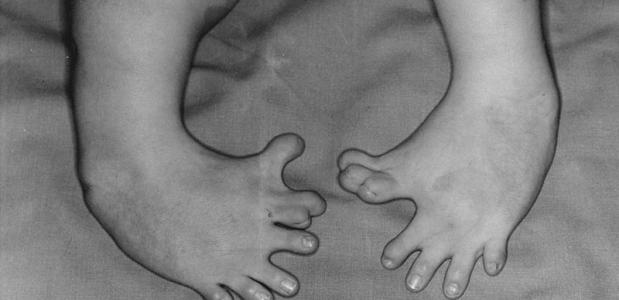 Afwijkende voetjes bij een Softenon-baby (Wikimedia Commons)