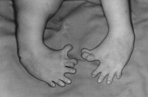 Afwijkende voetjes bij een Softenon-baby (Wikimedia Commons)