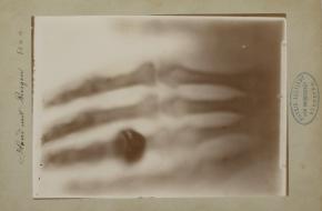 De oudste Röntgenfoto ooit met de hand van Wilhelm Röntgen’s vrouw, 22 december 1895. Bron: Collectie Teylers Museum.